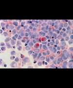 A slide of cancer cells