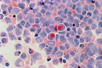 A slide of cancer cells